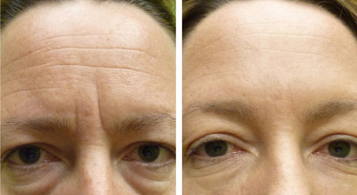Before and after Dysport for the “11’s” or glabellar lines and forehead