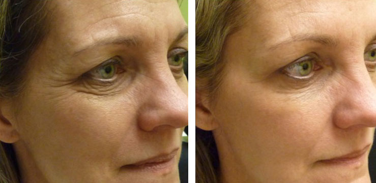 Before and after: Dysport to Crow's Feet and forhead, Restylane Lyft to the under eye area.