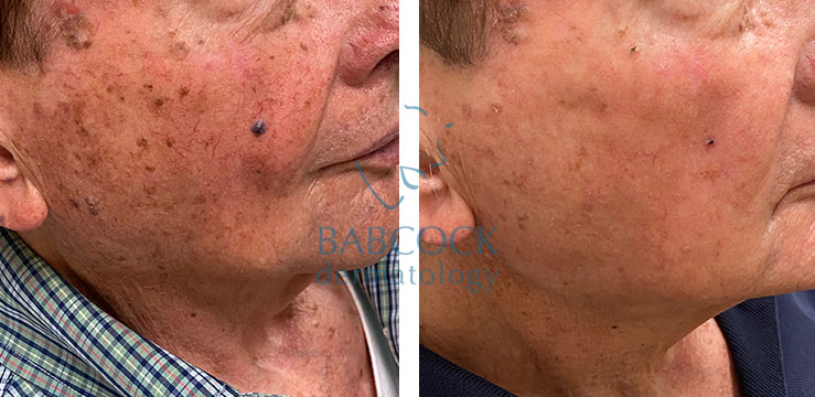 Before and After IPL PhotoFacial