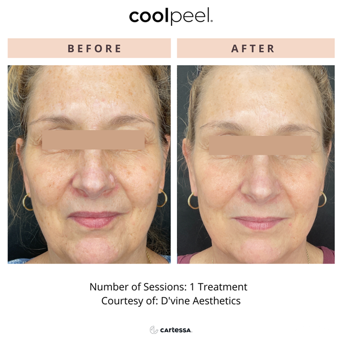 Before & after CoolPeel Treatment