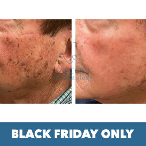 Red and Brown Texture Correction Treatment
