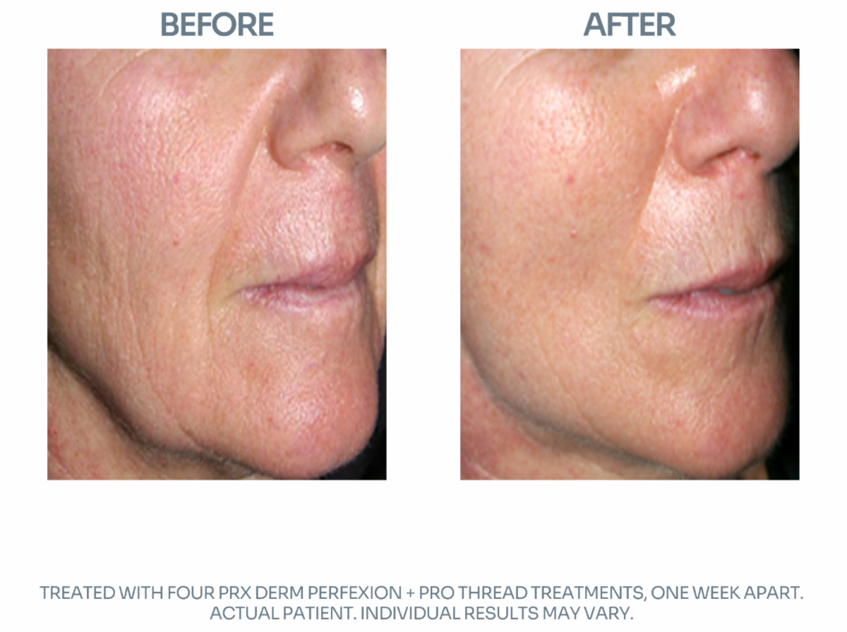 prxbeforeandafter