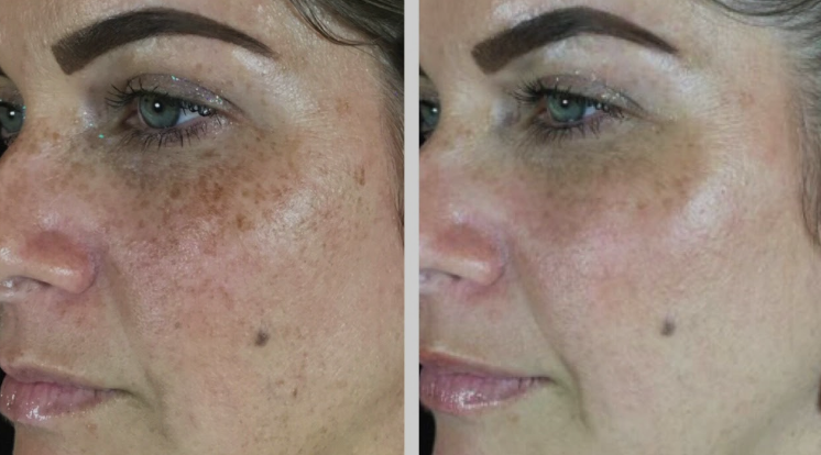 3 for me 3 FOR ME LASER TREATMENT FOR $999