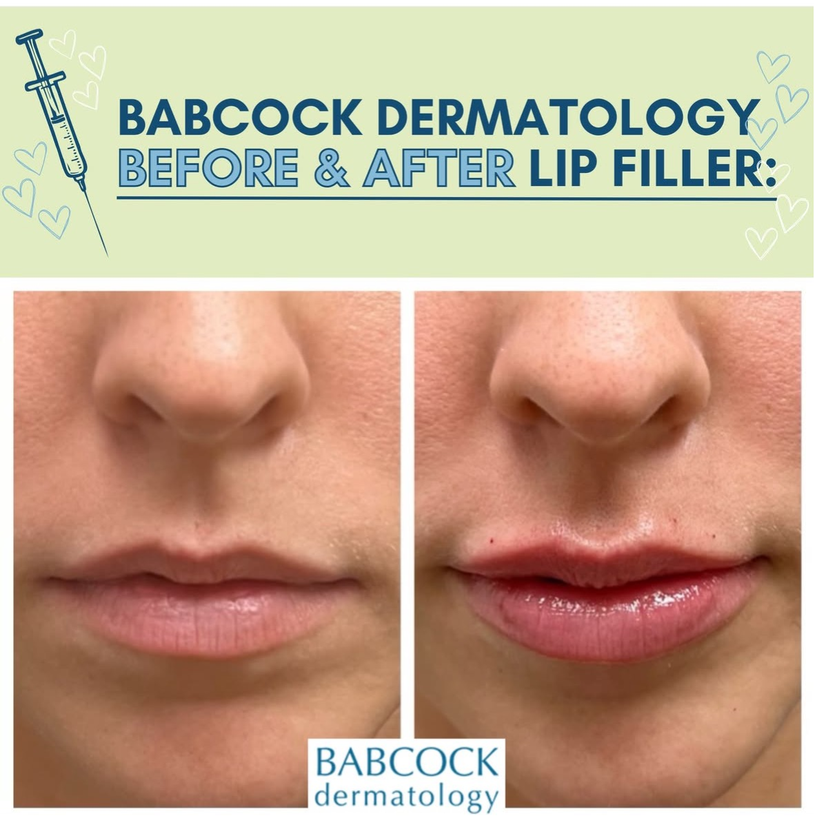 lip filler BE READY FOR VALENTINE’S DAY PLUMP YOUR LIPS LIP FILLER FOR $500