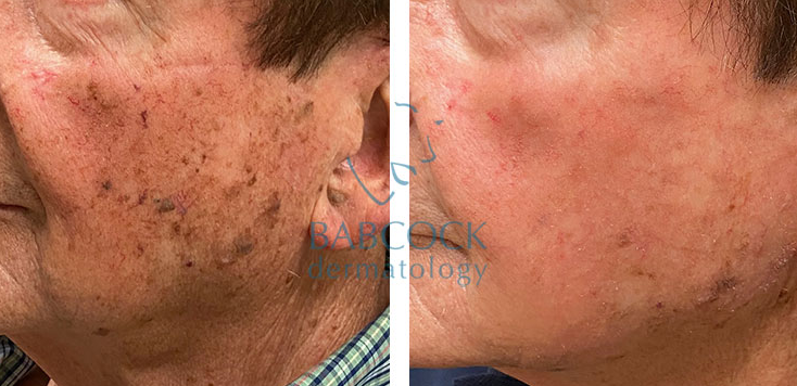 red brown RED BROWN TREATMENT FOR $999